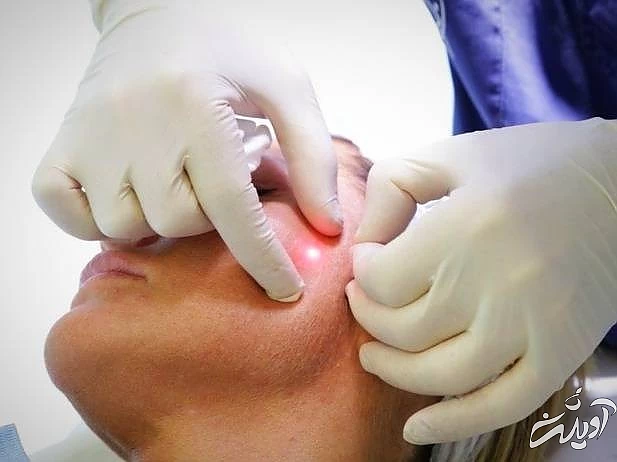 اندولیفت پوست صورت